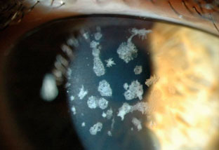 Distrofia Cornea Pre-Descemet: Una Patologia Oculare Progressiva.