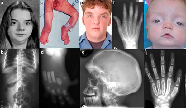Distrofia Cranio-Carpo-Tarsale: Una Patologia Rarissima