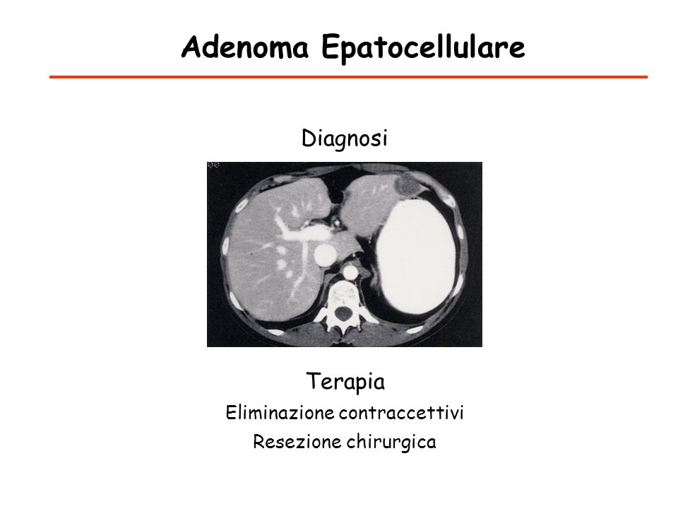 Adenoma epatocellulare una patologia epatica benigna