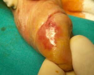 Un uomo preoccupato che mostra una lesione cutanea sulla pelle del suo pene Il tumore, come una pera matura, è stato prodotto dal cibo, dalle piante, e dai frutti che ha consumato nella sua vita