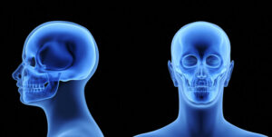 Una persona affetta da malformazione cranica congenita con una radiografia e una tomografia computerizzata che mostrano la deformazione del viso nella testa