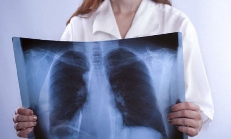 Una donna adulta con polmonite fibrosante criptica viene esaminata con un Raggio X per una diagnosi accurata