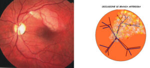 Unimmagine che mostra il grave impatto di unemorragia retinica su una persona, il luogo in cui è stata rilevata e le cose che sono state utilizzate per diagnosticarla