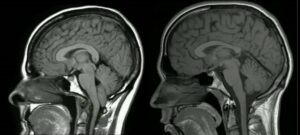 Un bambino sottoposto a risonanza magnetica per diagnosticare latassia cerebellare un esame per scoprire la causa dei disturbi del movimento, evidenziato dallo sguardo preoccupato del piccolo sulla sua testa e sulla sua espressione