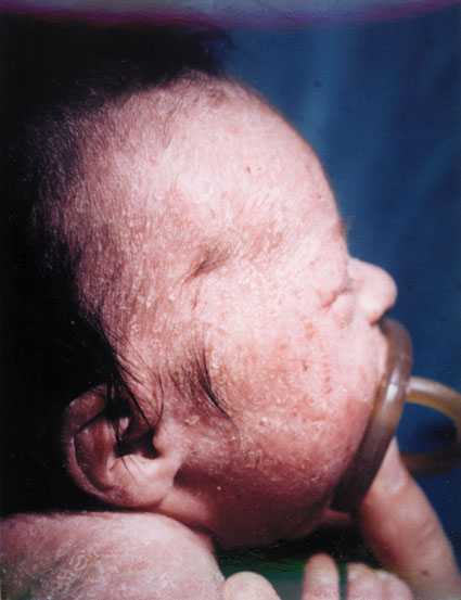 Ritratto di un bambino affetto da una complessa malformazione congenita Una fotografia che mostra la sua testa con la pipa da fumo in bocca e la pelle delicata
