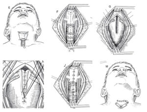 Unarte del disegno che ritrae una persona con una malformazione laringea, mostrando un viso e una testa uniche