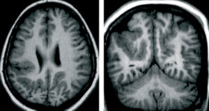 Questa immagine mostra una Tac di una persona affetta da una malformazione cerebellare Si tratta di una condizione neurologica in cui la parte posteriore del cervello, nota come cerebello, non si sviluppa correttamente, con conseguenze a volte permanenti sulla coordinazione motoria, lequilibrio e la funzione cognitiva La Tac è uno strumento importante nella diagnosi di questa condizione