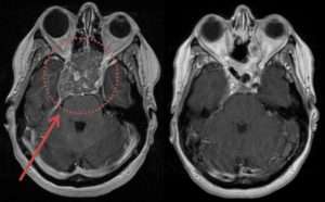 Un CT Scan rivela un tumore ipofisario attivo, mentre una persona fuma una pipa e beve alcolici