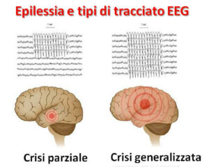 alternativo Rappresentazione di una persona che soffre di epilessia lisosomiale, una condizione neurologica genetica