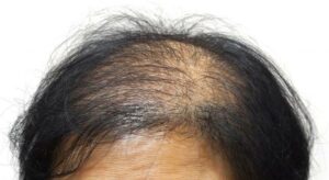 Una persona con una testa parzialmente calva, dita anomale e un viso scoperto, che rappresenta HairPersona la sfida di trovare un equilibrio tra cuoio capelluto, capelli e pelle