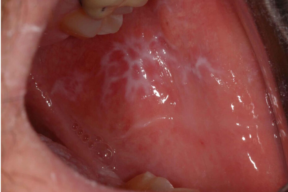Una persona con dermatite lichenoide cronica sta deglutendo un boccone di cibo con ketchup La sua lingua è visibile mentre è allinterno della sua gola, pronta a Swallow
