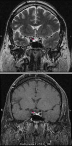 Questa immagine mostra una Tac Scan di una neoplasia ipofisaria, che ha una rilevanza diagnostica e terapeutica importante