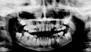 Unimmagine che mostra una persona con una malattia ossea immunitaria, effettuando una TAC della bocca e dei denti Limmagine include anche una radiografia della parte del corpo interessata