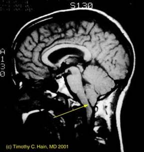 Una TAC mostra latrofia cerebellare, una patologia caratterizzata da una riduzione del volume del cervelletto che può portare a disturbi del movimento, dellequilibrio e della coordinazione