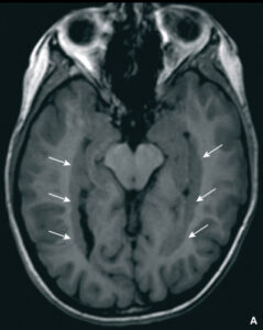 Una TC di una persona con malformazione cerebellare mostra una visuale ravvicinata del volto e della testa, rivelando dettagli di questa condizione neurologica