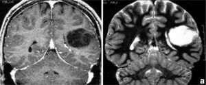 Una persona affetta da malformazione cerebellare, riconosciuta grazie alla Tomografia Computerizzata, mostra un viso preoccupato mentre guarda verso lalto con la testa
