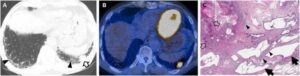 Tomografia Computerizzata di una malattia polmonare cronica una visione ravvicinata della realtà della patologia