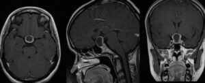 Questa immagine mostra una Tac Scan di una neoplasia ipofisaria mista La Tac Scan è una tecnica diagnostica usata per identificare le neoplasie e monitorarne levoluzione Questa particolare immagine mostra come le neoplasie miste possano interessare la ghiandola ipofisaria