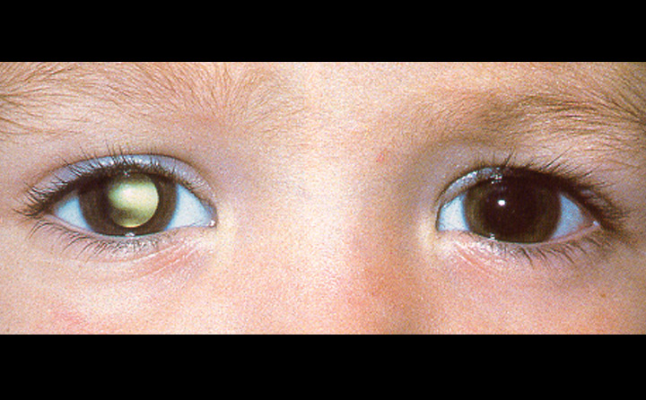 Un bambino sorridente con una lente a contatto nellocchio destro Una persona che ha subito un distacco retinico proliferativo, ma che non si arrende e guarda al futuro con fiducia