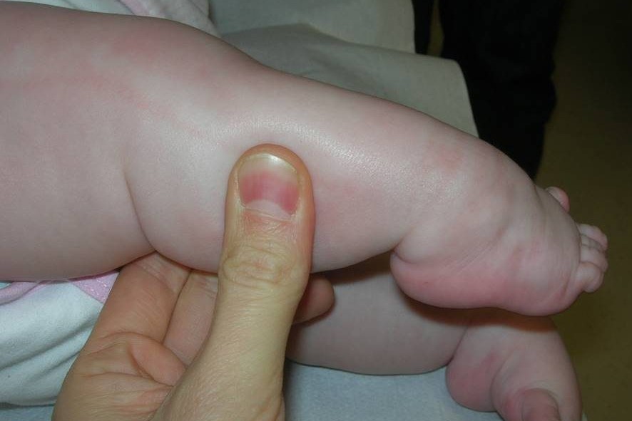 Una mano piccola e delicata mostra un bambino che soffre di distrofia muscolare congenita La pelle del dito mostra la fragilità della persona