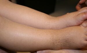 Un bambino che soffre di una malattia della pelle, mostrando come le sue condizioni influiscono sulla salute della sua pelle e sulla sua vita