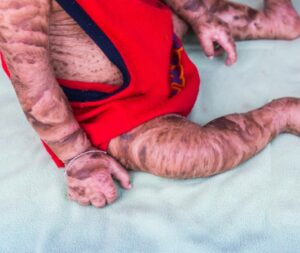 Un bambino con la LegPersona affetto da una malattia della pelle una parte del suo corpo coperta da un abbigliamento speciale, come un guanto, che protegge la sua pelle fragile sulla gamba e il braccio