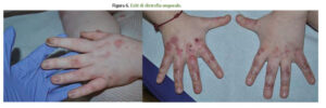 Una mano di un bambino che mostra una malattia della pelle, con unghie sottili che vengono massaggiate da NailPolso per prevenire ulteriori danni alla pelle e ai suoi dita