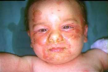 Un ritratto triste di un bambino con uneruzione cutanea neonata, scattato da ChildrenTesta per rendere visibile la sofferenza dei bambini
