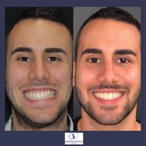 Questa immagine mostra un modello maschio adulto con dismorfia facciale acquisita La persona ritratta ha una barba ispida e un sorriso aperto mostrando i denti Il modello è identificato come ModelTesta