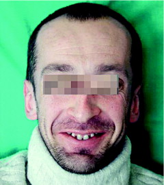 con Difetti Ritratto di un uomo adulto affetto da una malformazione genetica ereditaria una fotografia che mostra il viso della persona e i suoi difetti