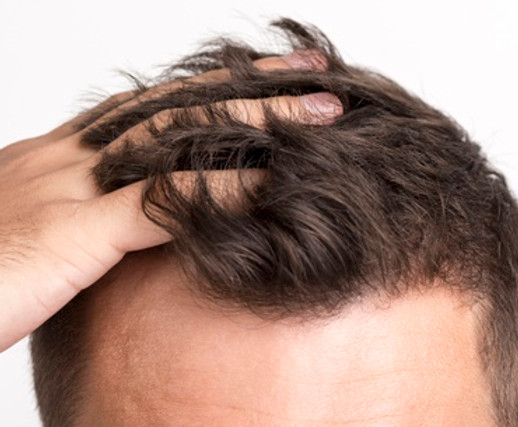 Un uomo adulto maschio con calvizie focale si reca dal parrucchiere per un taglio dei capelli Una rasatura accurata rimuove i capelli residui dal suo cuoio capelluto
