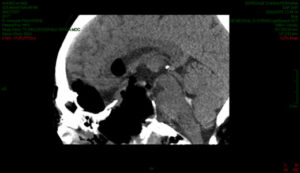 Questa immagine ritrae una persona che si sottopone a una risonanza magnetica nellospedale per diagnosticare una neoplasia ipofisaria
