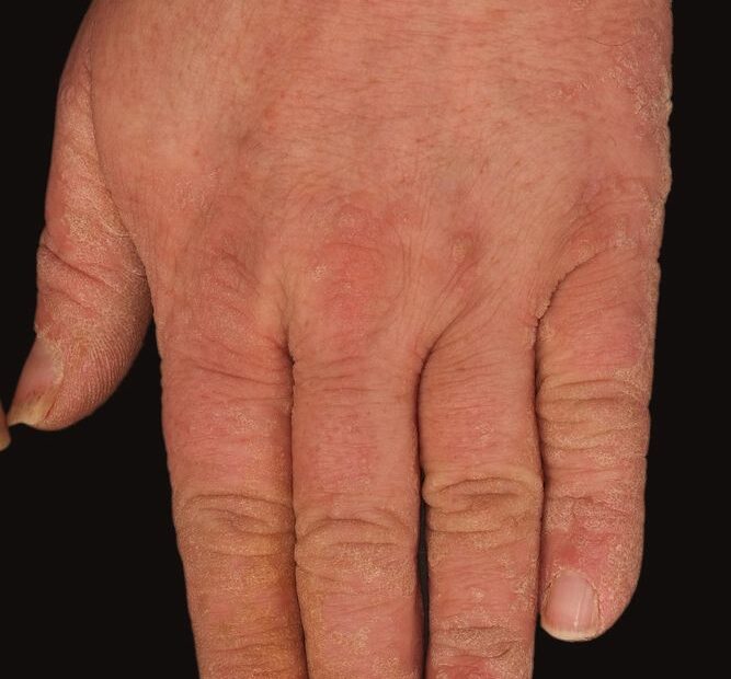 Una foto di un bambino con la mano aperta che mostra una malattia della pelle sulla pelle del polso Una storia di una persona che deve affrontare limpatto delle malattie della pelle su una delle parti più preziose del corpo, il braccio e il dito