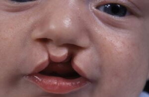 Un bambino con labiopalatoschisi cistica che mostra la sua bocca, una parte del corpo importante ed essenziale che gli permette di comunicare