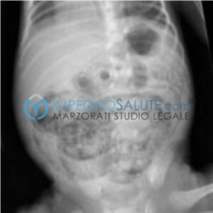 Una sposa adulta, una donna e una persona, vista con una radiografia per rivelare uninfiammazione intestinale mortale che ha interrotto il suo matrimonio