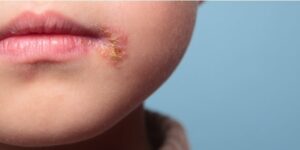 Questa immagine mostra un bambino che soffre di una malattia della pelle Si vede chiaramente la testa del bambino, il viso e la bocca Anche il naso e la parte superiore del corpo sono ben visibili Questa immagine è una rappresentazione di NosePersona, che mostra come le malattie della pelle possono avere un impatto su un bambino