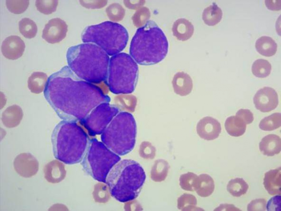 La Leucemia Acuta Mieloblastica di Tipo 4