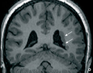 Immagine di una radiografia di un bambino con malformazione cerebellare, eseguita con una Tac e una Lavagna Interattiva, eseguita con Raggi X Una visione straordinaria della complessità della malformazione cerebellare, spiegata attraverso una Tecnica Avanzata di Raggi X e una Lavagna Interattiva
