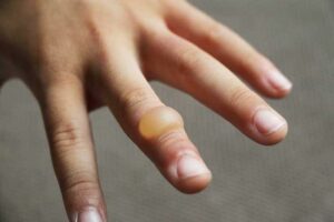 Una persona arrossata dalla malattia della pelle sulla sua mano, con un dito che mostra la pelle infiammata