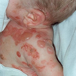 Un bambino con una malattia cutanea ereditaria, ArmTesta, mostra la parte del suo corpo interessata il viso, il collo, il braccio e la pelle