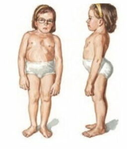 Un bambino affetto da distrofia muscolare che indossa un abbigliamento intimo ed un pannolino una persona che non si arrende