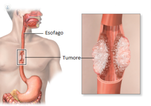 Una persona sofferente di tumore allo stomaco, con una parte del suo corpo aperta che mostra uno stomaco pieno di cibo, tra cui ketchup