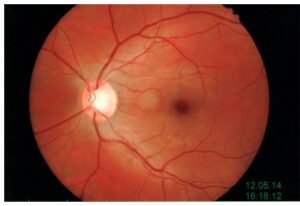 Una persona con emorragia retinica, mostrando la parte del corpo dove le emorragie possono essere un sintomo di una malattia dello stomaco