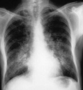 Una persona maschio soffre di una grave condizione di sangramento polmonare, rivelata da unimmagine a raggi X