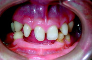 Una persona con una malformazione genetica ereditaria mostra la sua bocca con denti non allineati, mentre gusta una boccata di cibo condito con ketchup
