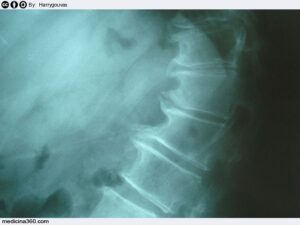 Raggio X mostra la malformazione spinale di una persona su un tavolo