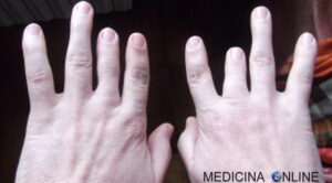 Questa immagine mostra una persona che ha un intelletto limitato, che ha le dita strette sulla mano sinistra con ununghia ben visibile Simboleggia come una piccola parte del corpo, come un dito, può avere un impatto significativo sulla vita di una persona