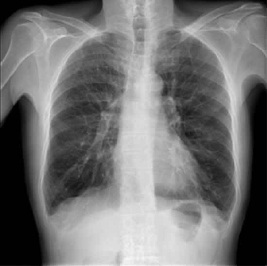 Una persona affetta da una malattia polmonare congenita al centro di una radiografia a raggio X in un ospedale, per diagnosticare la gravità della sua condizione