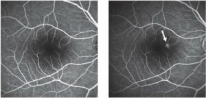 Una lavagna nera rappresenta il distacco retinico proliferativo, una malattia oculare che può portare alla perdita della vista se non trattata correttamente