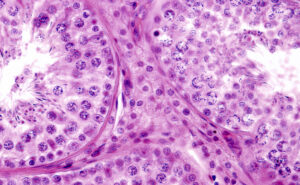Un asciugamano viola con un modello di carta su di esso, come rappresentazione di un tumore testicolare maschile, con carta igienica e tessuto intorno, come sostegno
